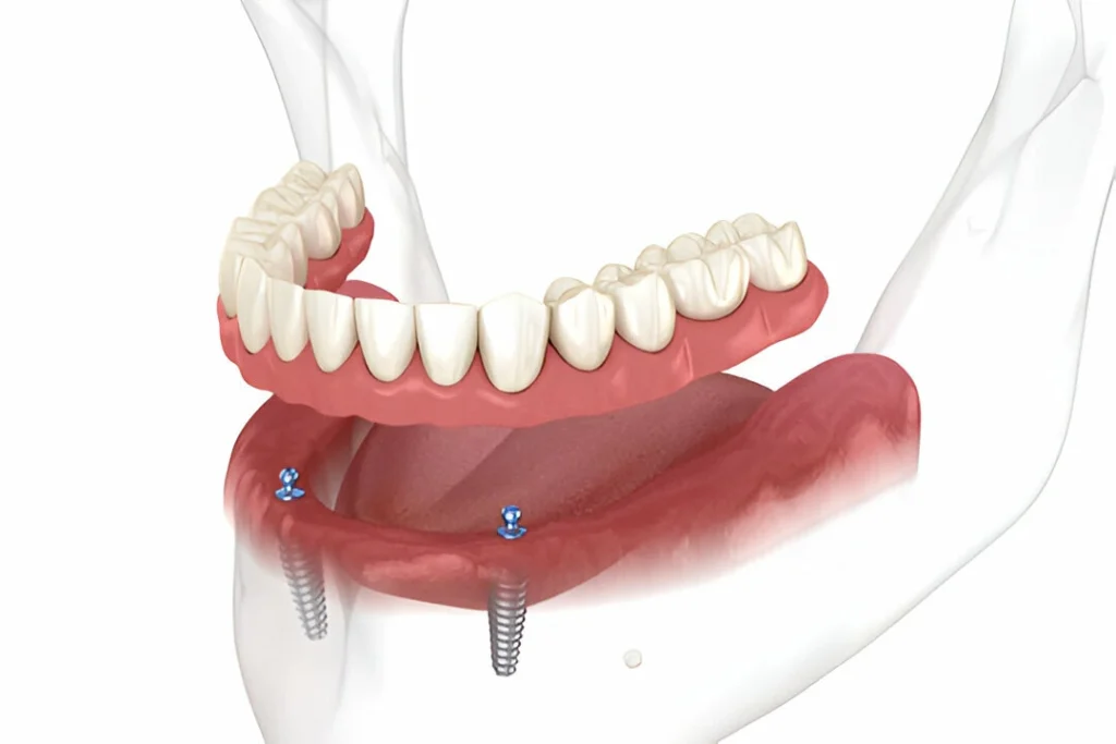 Get Overdentures Removal Treatment in Oceanside, California