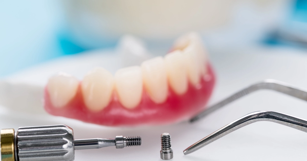 A dental implant screw, screwdriver tool, and dental picks arranged in front of a prosthetic lower denture for Overdentures in Oceanside, CA.