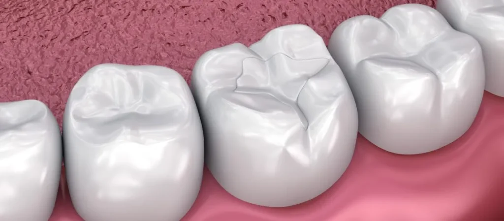 Dental Sealant Services in Oceanside, CA