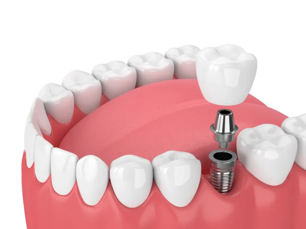 Dental Implants in Oceanside, CA