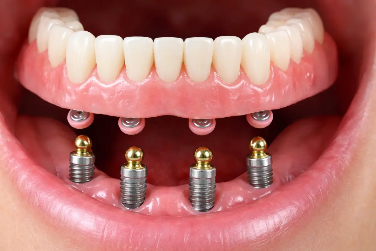 How Overdentures Attach to Dental Implants _ California Coast Dental Arts