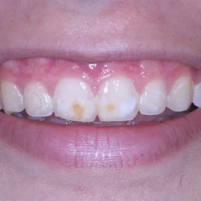 close up of a person's mouth | California Coast Dental Arts Before After D in Oceanside CA