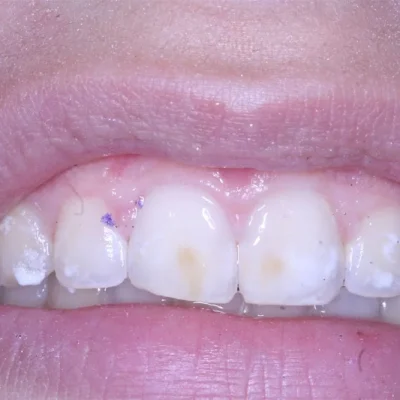 close up of a person's mouth | California Coast Dental Arts Before After E in Oceanside CA