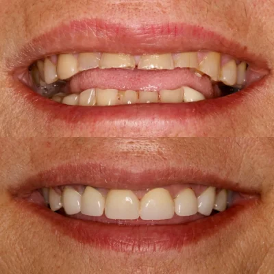 a close up of a person's teeth California Coast Dental Arts Before After Full Mouth Reconstruction B in Oceanside CA